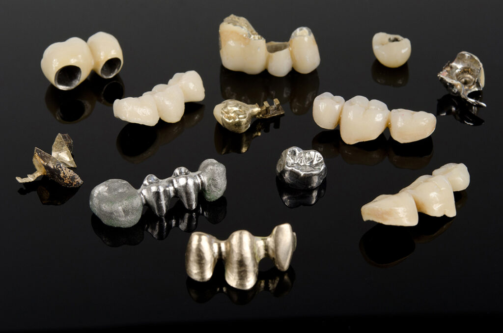 dentALEX Eigenschink Leistungen Metallkeramik