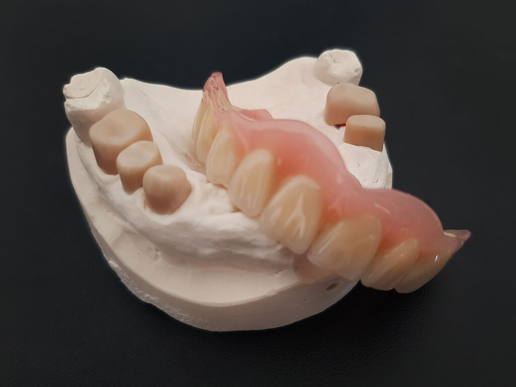 dentALEX Leistungen Teleskoptechnik